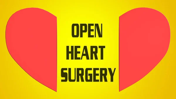 Illustratie Van Open Heart Surgery Tussen Rode Split Hart Geïsoleerd — Stockfoto