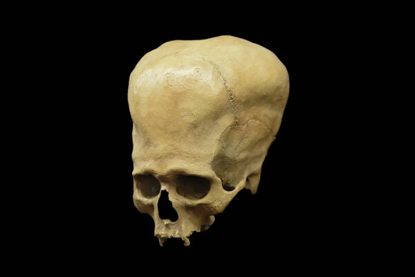 Cuzco / Peru - 07.12.2017: Deformed ancient Peruvian Skull. isolated, black background.