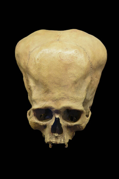 Cuzco / Peru - 07.12.2017: Deformed ancient Peruvian Skull. isolated, black background.