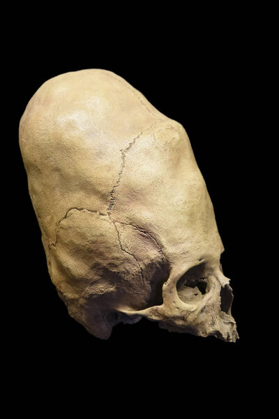 Cuzco / Peru - 07.12.2017: Deformed ancient Peruvian Skull. isolated, black background.