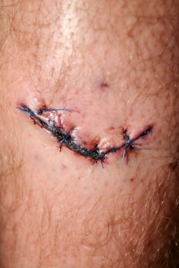 Bacağın tibial kemiğinde geniş taze kanlı yaralanma yarası. Kesme tutmak için dikiş yapıştırma.