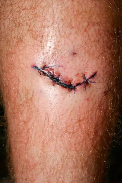 Wide fresh blooded injury wound on the tibial bone of the leg. Sticking stitches to hold the cut.