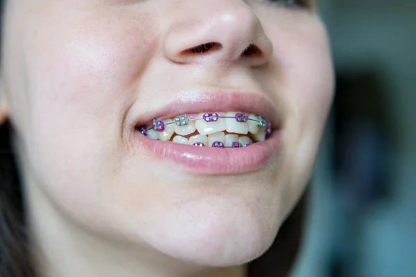 Smiling Woman Brackets — Stock Photo, Image