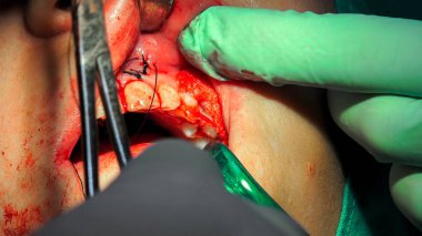 Kız dişçi Endodontik diş kanal uygulama doldurma sırasında