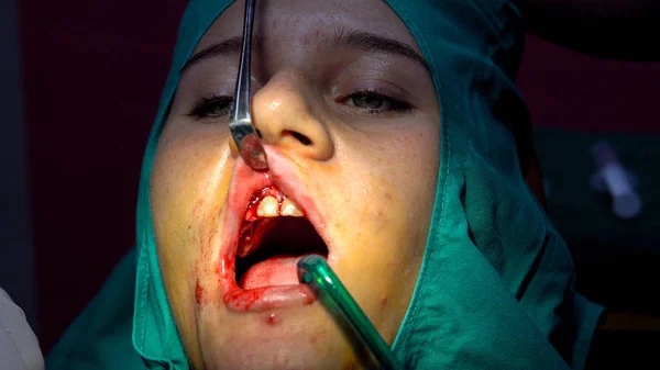 Metal stitch needle closes wound from curgical operation of tooth cyst removal