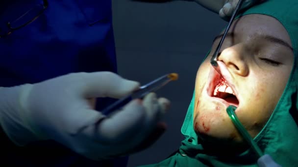 Oralchirurgie Operation Entfernung Von Zahnfleischapikoektomie Zysten — Stockvideo