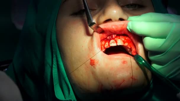 Стоматолог Накладывает Швы Женщинам Десну После Операции Удалению Кисты — стоковое видео