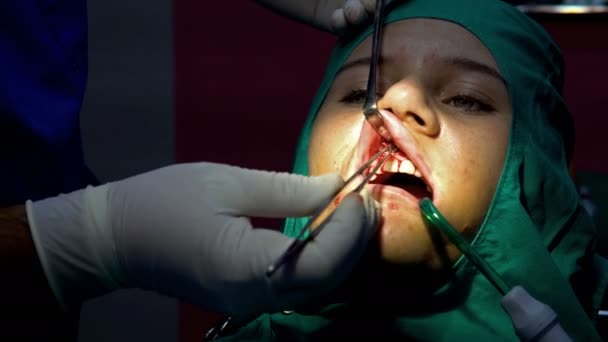 Oralchirurgie Cist Apikoectomy Dunkler Operationssaal — Stockvideo