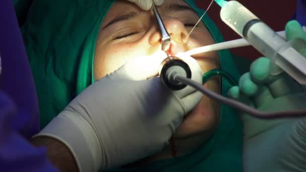 Жінка Хірургії Зубів Медична Операція Оральна Хірургія Апоксектомія Темній Операційній — стокове відео