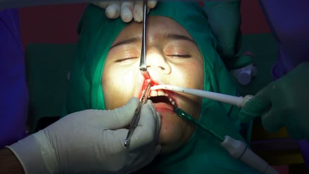 歯科インプラント手術 Apicectomia ガム操作 クローズ アップ — ストック動画