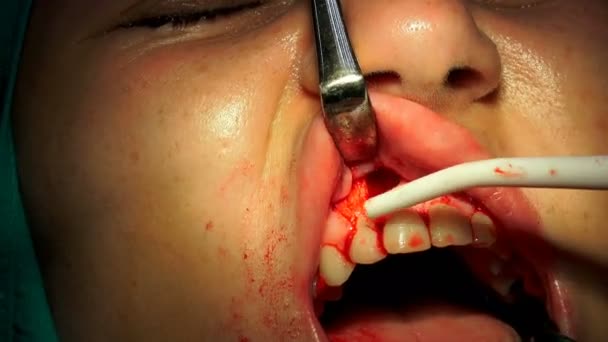 Cirugía Implantes Dentales Operación Encía Apicectomia Primer Plano — Vídeo de stock