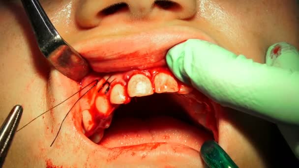 歯科医師ステッチ口腔の嚢胞の除去手術後の針の傷 — ストック動画