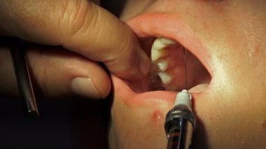 Diş hekimi uygulamak oral cerrahi operasyon, closeup öncesi anestezik enjeksiyon