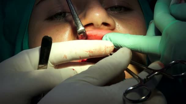 Costurar Ferida Paciente Operação Cirurgia Oral Sala Escura — Vídeo de Stock