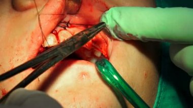 Diş hekimi dikiş kadın sakız diş cerrahi operasyon kist kaldırma sonra