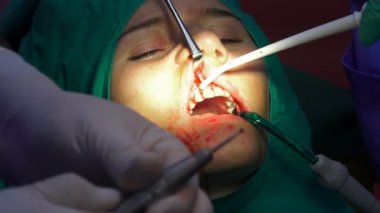Diş cerrahisi tıbbi operasyonunda kadın. Ağız cerrahisi, karanlık ameliyathanede apikektomi