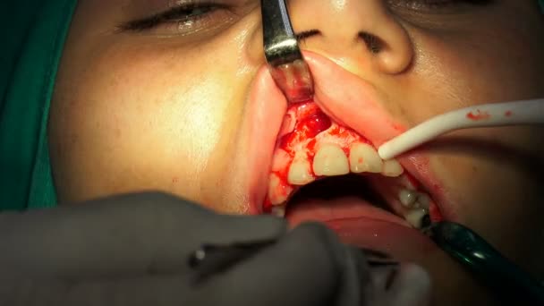 Oralchirurgie Cist Apikoectomy Dunkler Operationssaal — Stockvideo