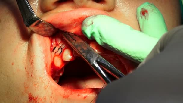 Metal Stitch Needle Closes Wound Curgical Operation Tooth Cyst Removal — Stock Video