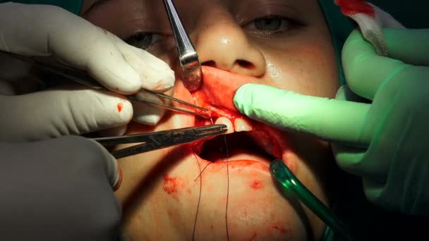 Médico Dentista Segurando Suporte Agulha Para Costurar Ferida Sala Cirurgia — Vídeo de Stock