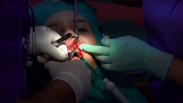 Stitching Wound Patient Oral Surgery Operation Dark Room — Stock Video