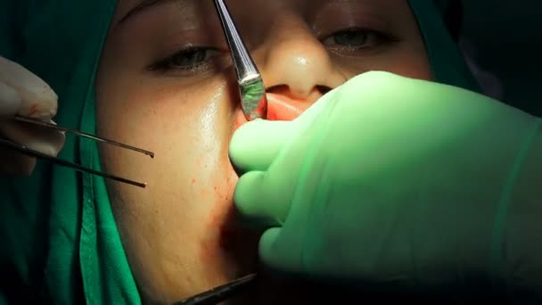 口腔外科 手術針で傷口を縫う — ストック動画