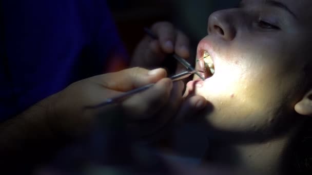 Dívka Zubaře Při Endodonic Zubu Chanel Aplikace Pro Vyplňování — Stock video