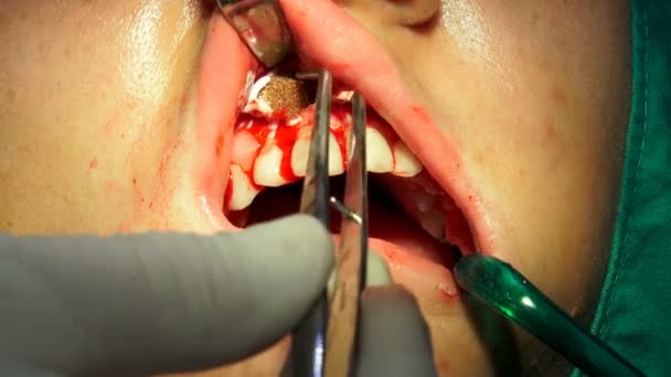Nastolatek Twarzy Podczas Zabiegu Apicactomy Torbiel Remaval — Wideo stockowe