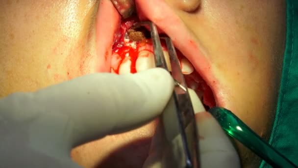 Женщина Зубной Хирургии Медицинская Операция Операция Полости Рта Апиктомия Темной — стоковое видео