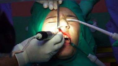 Ağız diş cerrahi operasyon, diş diş eti apicoectomy kist kaldırma