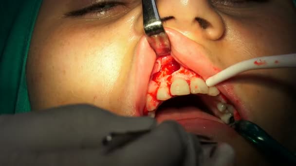 Oralchirurgie Cist Apikoectomy Dunkler Operationssaal — Stockvideo