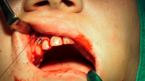 Lekarz Dentysta Trzymając Uchwyt Igły Szycia Rany Sali Operacyjnej — Wideo stockowe