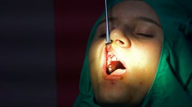 Apicactomy kist remaval cerrahi operasyon sırasında genç yüzü