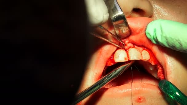 Metal Stitch Needle Closes Wound Curgical Operation Tooth Cyst Removal — Stock videók