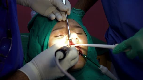 Cirugía Dental Oral Extirpación Quistes Con Apicactomía Encías — Vídeo de stock