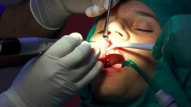 歯科インプラント手術 Apicectomia ガム操作 クローズ アップ — ストック動画