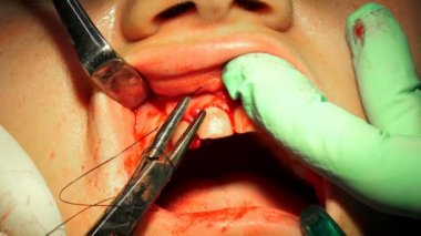 Oral cerrahi, cerrahi tel holden yarayla kelepçe yakın çekim tarafından dikiş