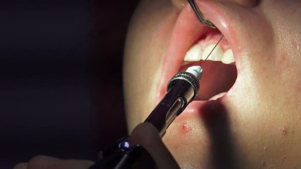 Dentista Com Agulha Seringa Faz Desinfecção Dos Canais Dentários Antes — Vídeo de Stock