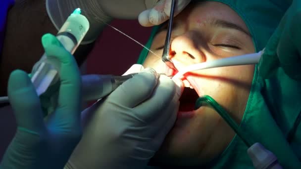 Chirurgia Stomatologiczna Dental Operacji Guma Apicoectomy Torbiel Zęba — Wideo stockowe