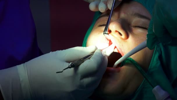 Ústní Zubní Chirurgie Operace Odstranění Zubu Dáseň Apicoectomy Cysta — Stock video