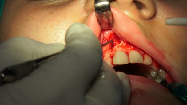 Menina Dente Goma Cirurgia Oral Apicectomia Sala Operação Escura — Vídeo de Stock