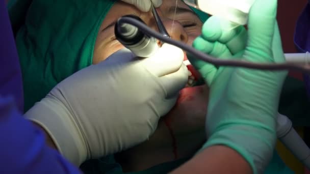 Diş Cerrahisi Tıbbi Operasyonunda Kadın Ağız Cerrahisi Karanlık Ameliyathanede Apikektomi — Stok video