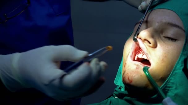 Cirurgia Dentária Oral Operação Remoção Cisto Apicoectomia Gengiva Dentária — Vídeo de Stock