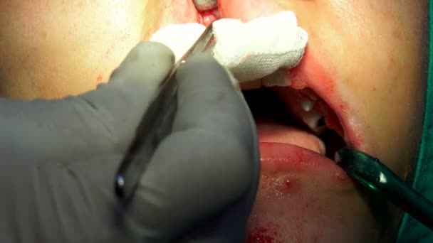 Oral Surgery Operation Cist Apicoectomy Dark Operation Room — Stock Video