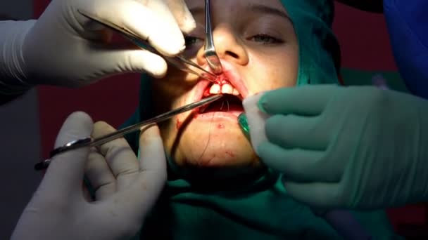 Oralchirurgie Cist Apikoectomy Dunkler Operationssaal — Stockvideo