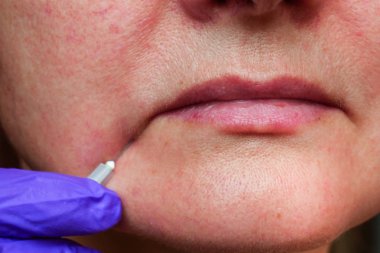 Bir kadının derisinin altında kozmetik enjeksiyonlar, yaşlanmayı önleyici.