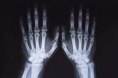 Tıbbi x ray eller görüntü