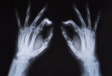 Tıbbi x ray eller görüntü