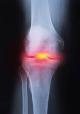 Tıbbi x-ray diz artrit (gut, romatoid artrit, septik artrit, osteoartrit diz eklem resimle )