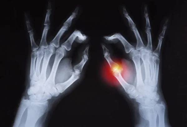Röntgenbild Der Menschlichen Hand Rot Hervorgehoben — Stockfoto