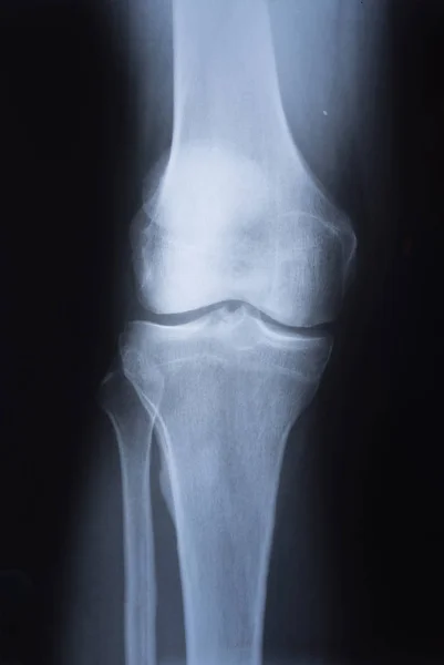 膝の医用 線画像 — ストック写真